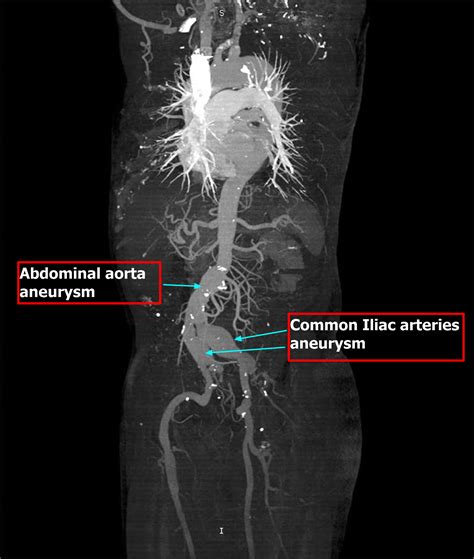 Iliac Artery - Common iliac artery, Internal & External iliac artery ...