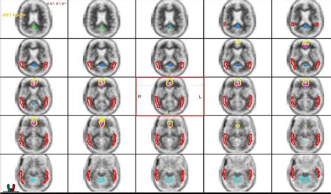 Amyloid PET/CT - Shields