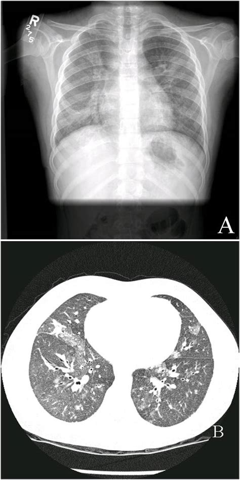 Diffuse alveolar hemorrhage - Cancer Therapy Advisor