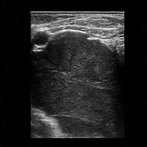 -Ultrasound-guided biopsy of right anterior mediastinal mass. (A ...