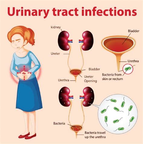 Urinary Tract Infection Women