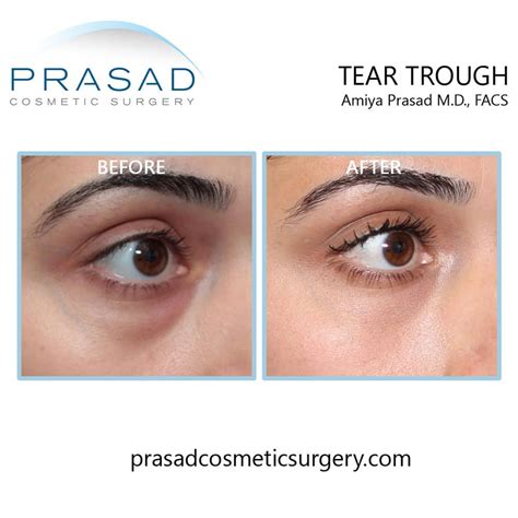 Effective Treatment Options for Bags Under the Eyes | Dr. Prasad Blog