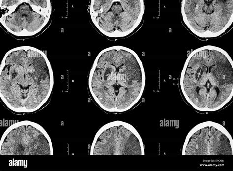 Ischemic stroke : ( CT of brain show cerebral infarction at left ...