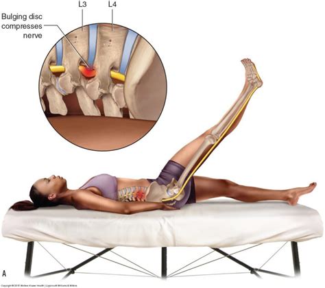 How do we assess (diagnose) a client with sciatica?