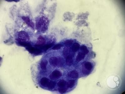 Lung cancer metastasis to pleural fluid