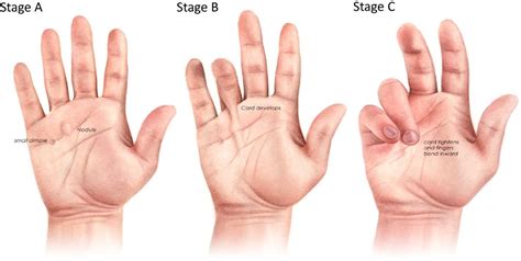 Dupuytren's: a systems biology disease | Arthritis Research & Therapy ...