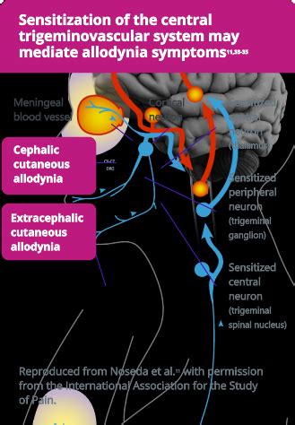 Pathophysiology of Migraine | Science of Migraine