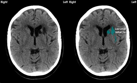 Lacunar Infarct Mri