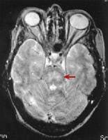 Psychology of Medicine: Central pontine myelinolysis