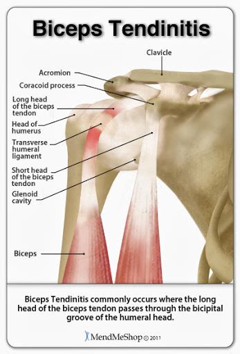 Bicep Tendonitis