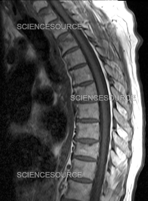 Photograph | Bone marrow edema, MRI | Science Source Images