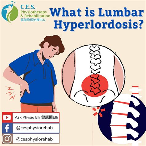 Posture Deviation – Lumbar Hyperlordosis