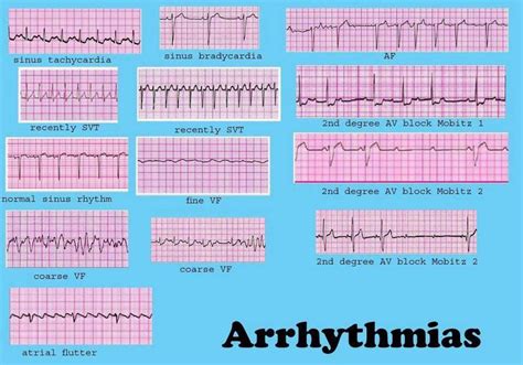 dysrhythmia interpretation | Nursing notes, Nurse, Nursing cheat