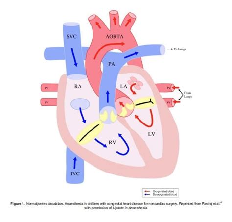 Anaesthesia in Children With Congenital Heart Disease for Noncardiac ...