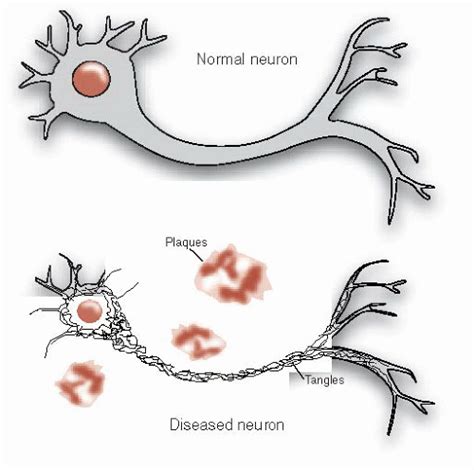 Alzheimer’s Disease | Neupsy Key