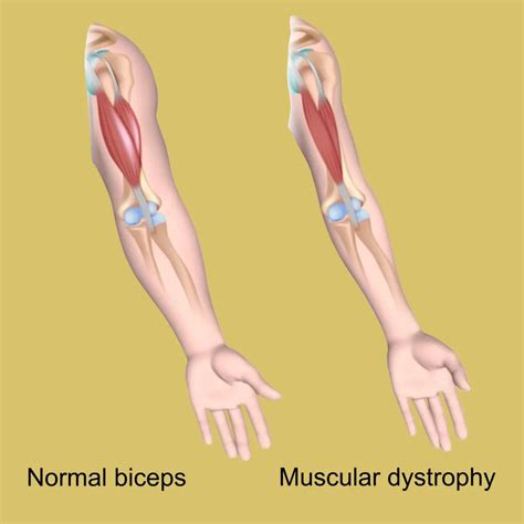 Progressive Muscular Atrophy (PMA) - 247 Medical Equipment LLC