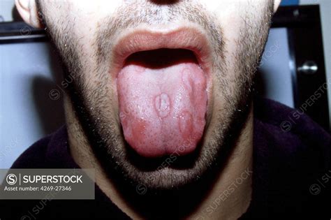 Syphilis. Secondary syphilitic chancre (ulcer) on the tongue of man ...