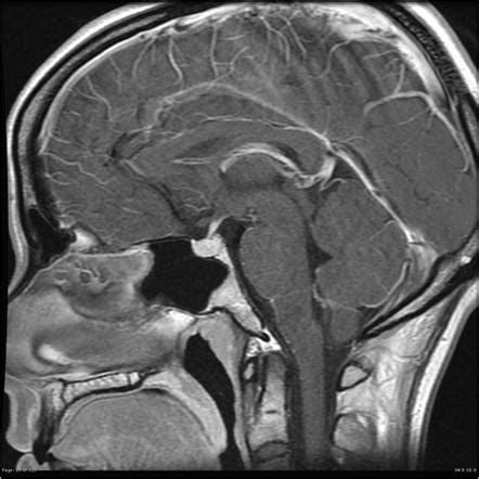 Pituitary Mri Brain Anatomy