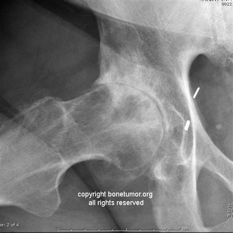 Subchondral cyst | BoneTumor.org