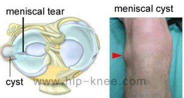 Meniscal cysts - Hip and Knee clinic