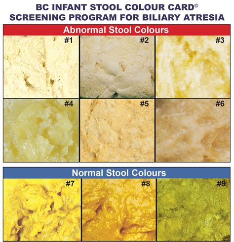 Collection 94+ Pictures Pictures Of Abnormal Stool Samples Latest