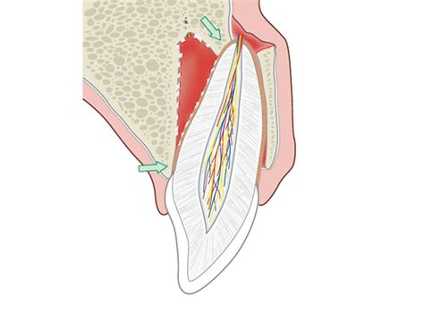 Lateral Luxation of tooth - prognosis, management and treatment | News ...