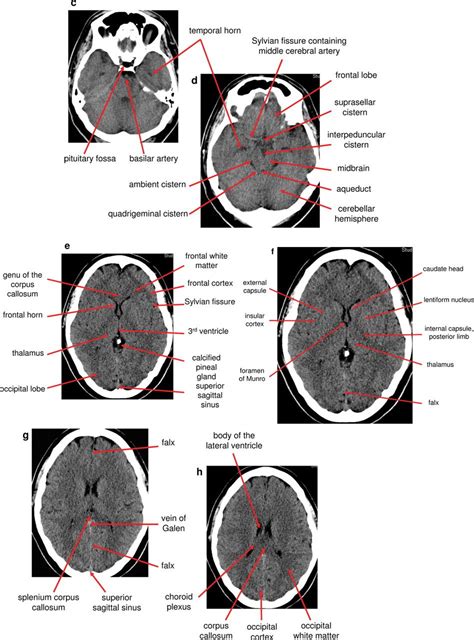 Anatomy Of Head Ct Scan Normal The Brain On Ct And Mri With A Few ...