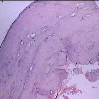 Cementoblastoma Histology