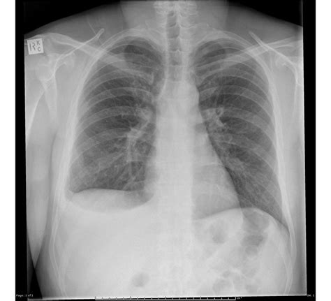 Pleural Effusion X Ray : Pleural Effusion - Undergraduate Diagnostic ...