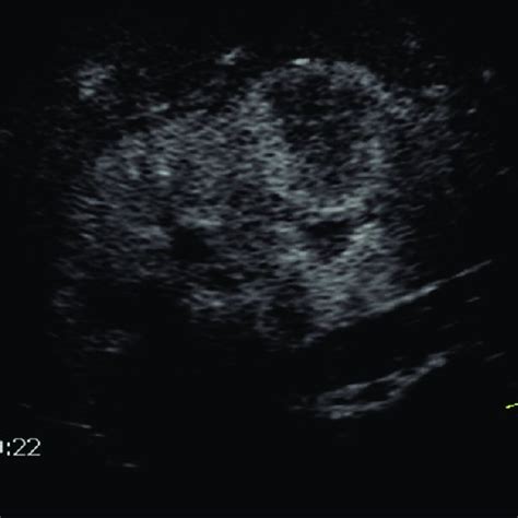 (PDF) Harmonic Contrast-Enhanced Ultrasound (CEUS) of Kidney Tumors