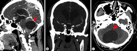 Arachnoid cyst causes, symptoms, diagnosis, prognosis and treatment