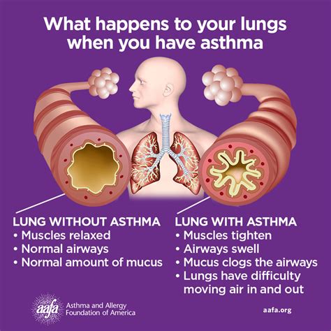 Scientists unveil potential asthma treatment, raising hope for patients ...