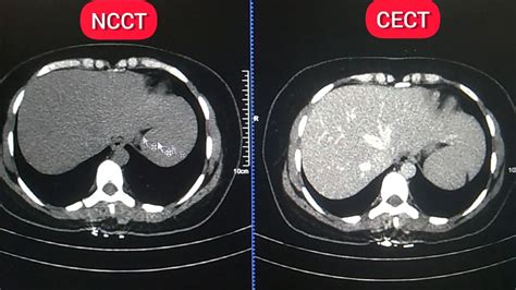 What's The Difference Ncct And Cect Whole Abdomen? |Difference Plane ...