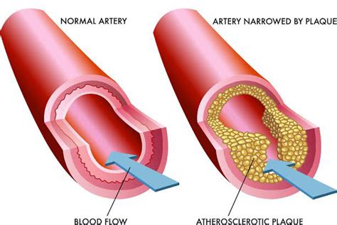 Atherosclerosis: Symptoms, Causes, Diagnosis, and Treatment