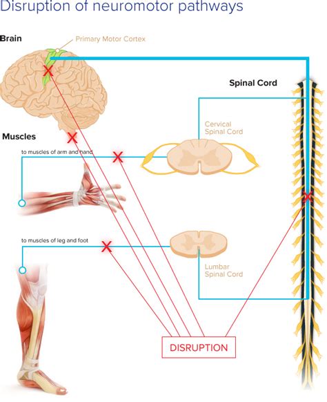 Disrupted Neural Pathways – PathMaker Neurosystems