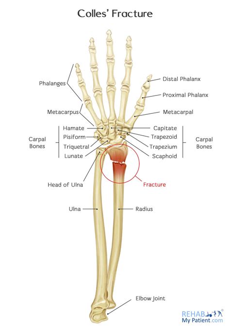 Colles’ Fracture | Rehab My Patient