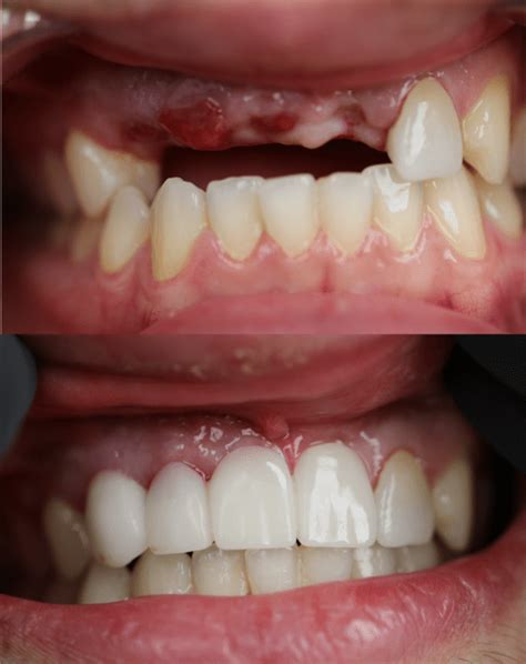 Tooth Implant Before After