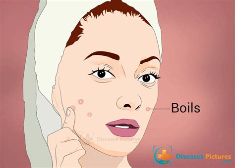 Boils (Skin Abscess) – Symptoms, Causes, Treatment, Prevention | #site ...