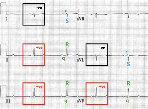 Left Posterior Fascicular Block (LPFB) • LITFL • ECG Library Diagnosis