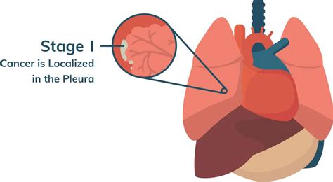 Malignant Mesothelioma Cancer | Stages, Prognosis, Treatment