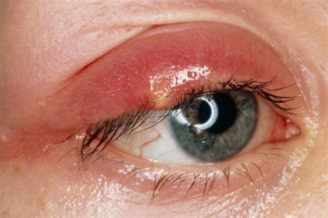 Eyelid Pimple Inside