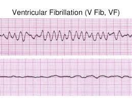 v fib ecg - Google Search | Google search, Cardiology