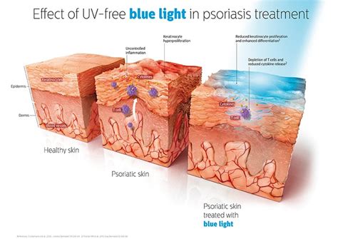 Effective, Empowering and Life-Changing: New blue light therapy with ...