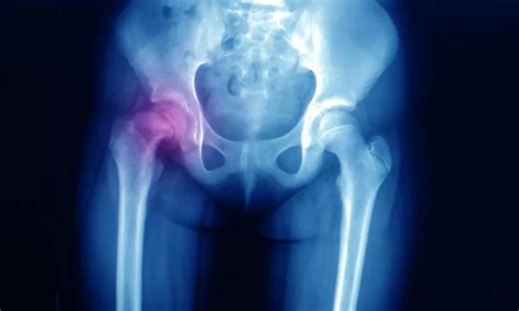 Total Hip Replacement: How to Minimize the Risk of Dislocation ...