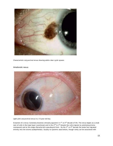 Conjunctival tumors