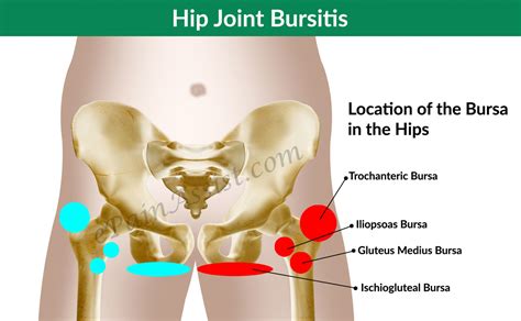 Hip Joint Bursitis & Tendinitis- Causes, Signs, Symptoms, Diagnosis ...