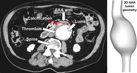 Automated AAA detection on CT scans - Diagnostic Image Analysis Group