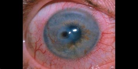 Cornea: Overview of Corneal Diseases and Common Symptoms