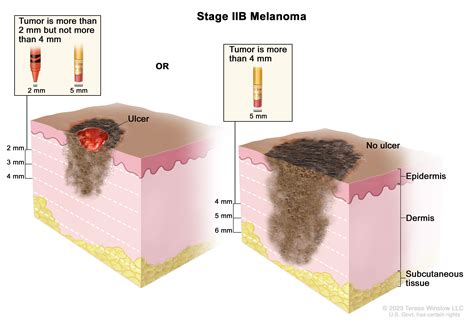 Melanoma Treatment - NCI