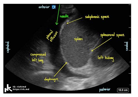 Ultrasound Pleural Effusion And Spine Sign | RK.MD